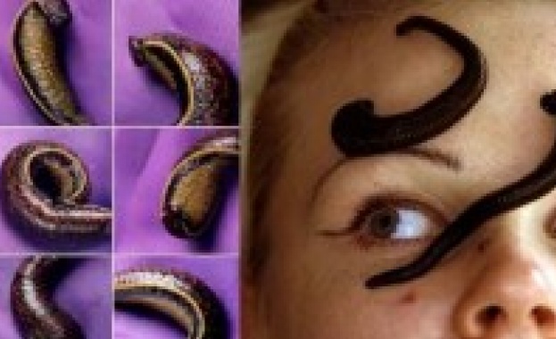 Спасиха лице на шведка с помощта на 350 пиявици 