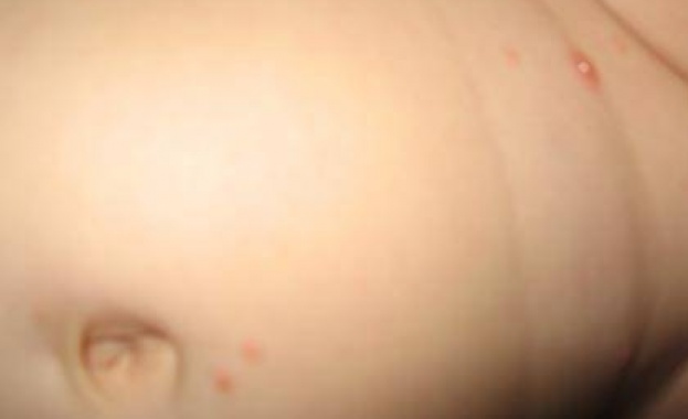 Някои инфекциозни заболявания се развиват което води до повторно заразяване