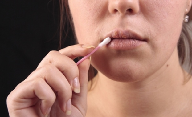 Херпесът е вирусно заболяване характеризиращо се с обрив на групирани