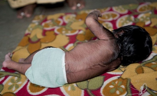В Индия се роди бебе-върколак /снимки/