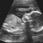 НПО-та настояват за корекция в нормативната уредба за аборт и раждане