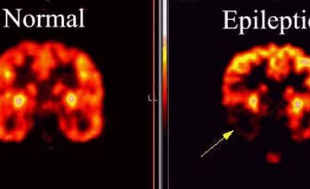 26 март е Световен ден в подкрепа на страдащите от епилепсия