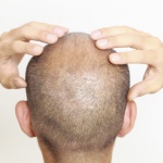 Учените са установили причината за оплешивяването