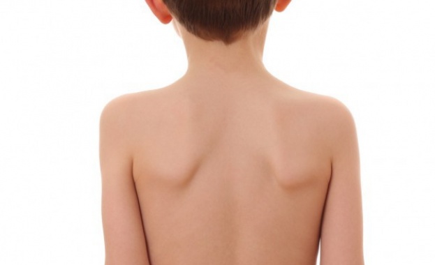 Всеки пети ученик в Плевен има гръбначно изкривяване