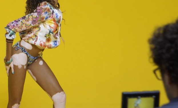 Момичето с два цвята на кожата