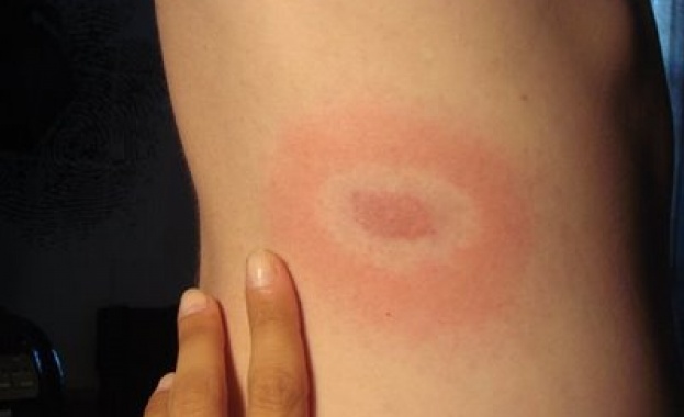 Изолираха диагностициран с лаймска болест от Казанлък