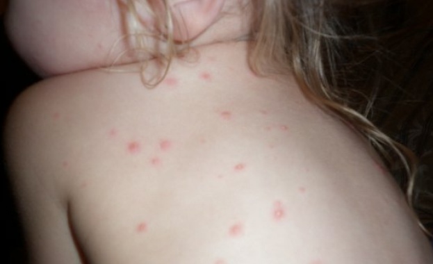 При варицела не се дава антибиотик 