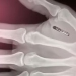 Американец си имплантира безжични чипове в ръцете 