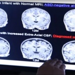 Изкуствен интелект засича аутизъм