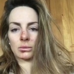 Сани Жекова с ожулено лице и извадено рамо