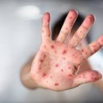 Случаите на морбили в страната са 408, регистрираните случаи са в 11 области