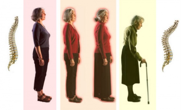 Половината жени над 70 г. в Европа страдат от остеопороза