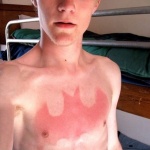 Татуировки - изгорени на слънце - най-лошата тенденция