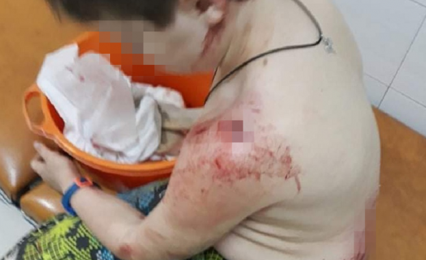 10 годишно момче беше нападнато и жестоко нахапано от 50 килограмово куче