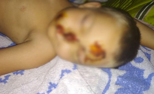 6 годишно дете беше жестоко нахапано от съседско куче в село