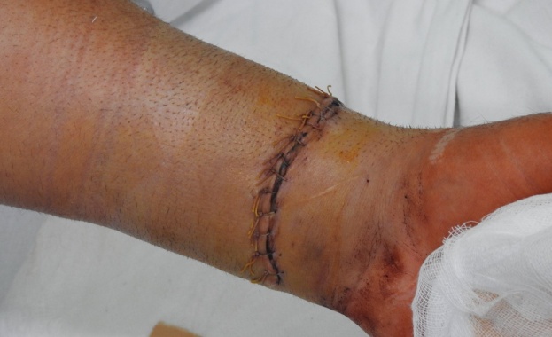 Разполагахме с 1 час превозването на пациента от Кърджали бе