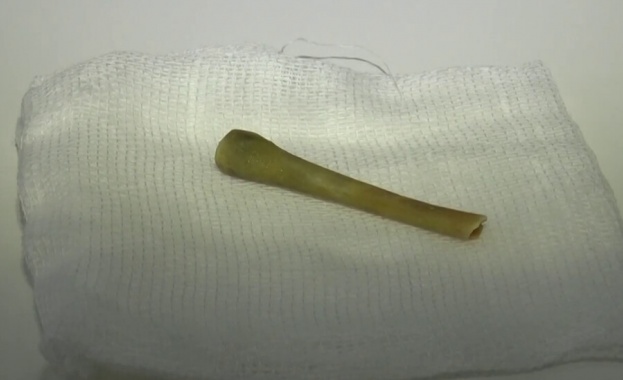 Пациент лекуван за пневмония в продължение на четири месеца се