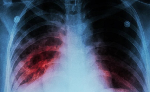 НЦЗПБ: В 12 области заболеваемостта от туберкулоза е над средната