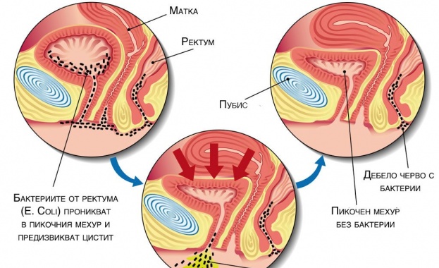 Д-р Живко Сиромахов обяснява причините за честите уроинфекции при жените