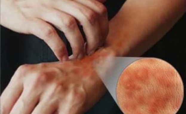 Зачервена и сърбяща кожа най често по ръцете лицето вътрешната