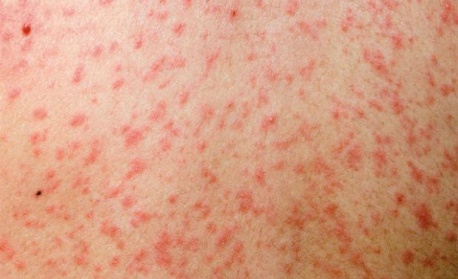 Ръст на случаите с морбили: Инфекциозното отделение в Бяла Слатина е пълно