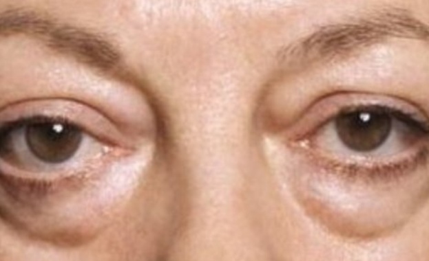 Торбичките под очите могат да направят лицето ви да изглежда