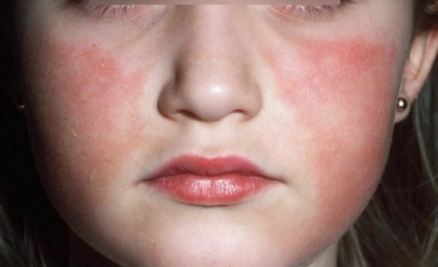 Петата болест е вирусна инфекция която може да доведе до