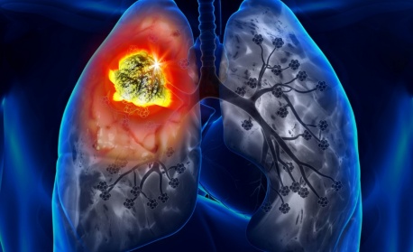 Борба с туберкулозата - седмица на отворените врати и безплатните прегреди