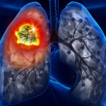 Борба с туберкулозата - седмица на отворените врати и безплатните прегреди