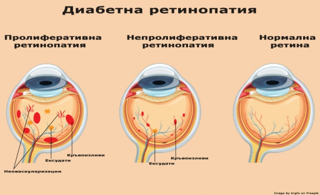В България липсва програма за ранно откриване на едно от най-сериозните усложнения на диабета - диабетната ретинопатия