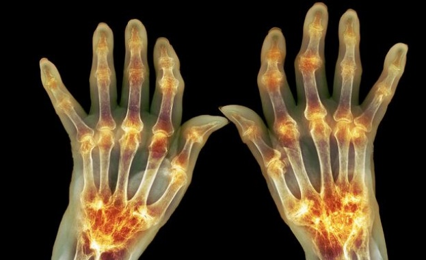 70 000 българи с ревматоиден артрит искат по-добър достъп до здравни грижи и лечение