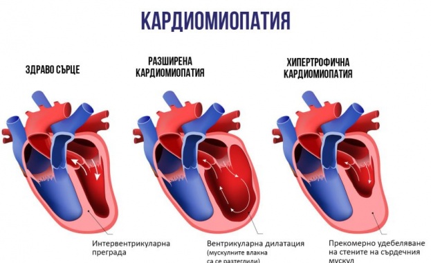 Стартира кампания за ранна диагностика на животозастрашаващо сърдечно заболяване