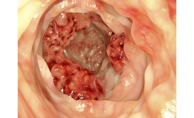 Упражненията могат значително да намалят риска от рак на дебелото