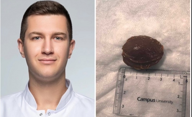 Лекари от Пловдив спасиха пациент след заседнала костилка в хранопровода