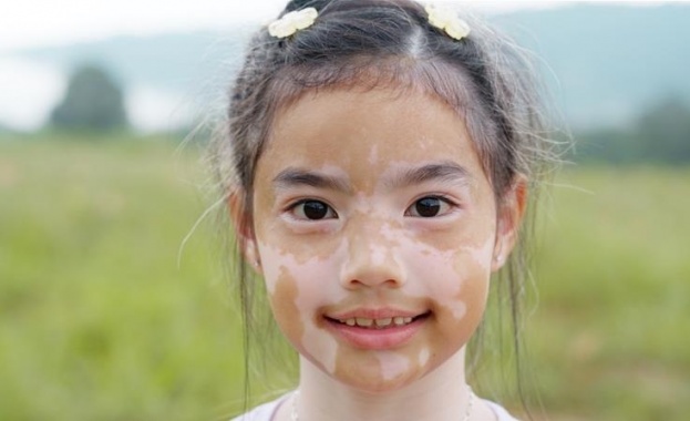 Родителите на деца между 6 и 12 г с витилиго