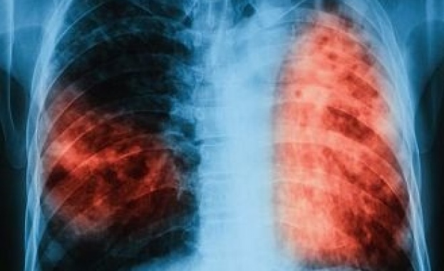 Един случай на туберколоза е открит при преглед в МБАЛ