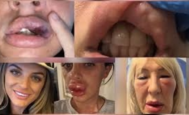 Ръст на заловените нелегални количества ботулинов токсин през последната година