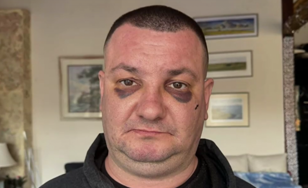 Мъж твърди че е жестоко пребит в дискотека в Троян