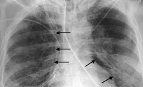 Регистрираха първи случай на Ку-треска за годината