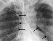 Регистрираха първи случай на Ку-треска за годината