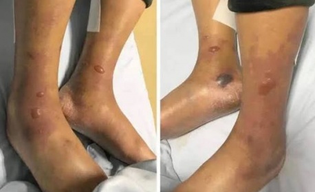 Опасна бактерия в Черно море: Как да се предпазим от Вибрио вълнификус