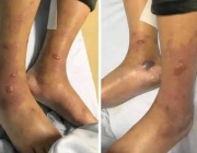 Опасна бактерия в Черно море: Как да се предпазим от Вибрио вълнификус
